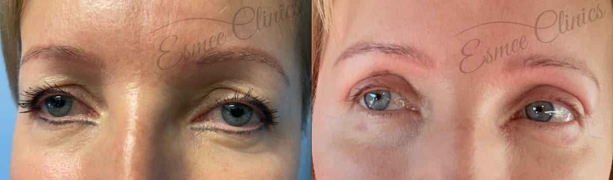 Before and After img